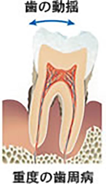 歯周病によるぐらつきの様子