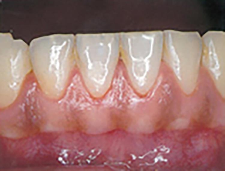 歯周炎の写真