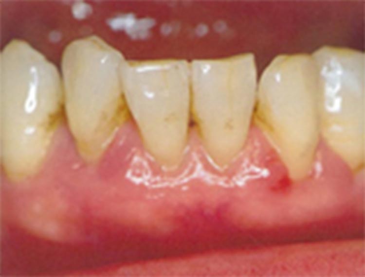 中等度歯周炎の写真