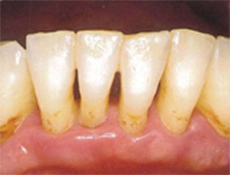 進行した歯周炎の写真