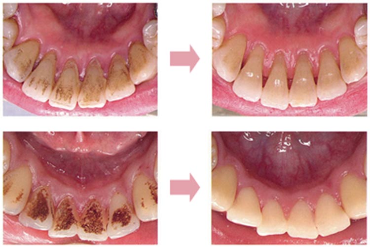 歯石や着色などをキレイにする前と後の写真