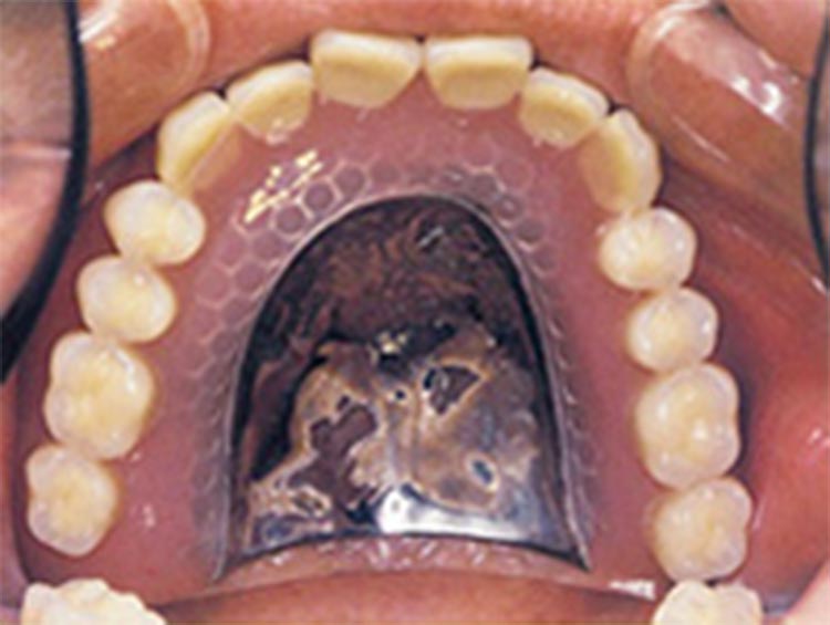 金属床の入れ歯の写真
