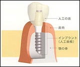 インプラント治療の図