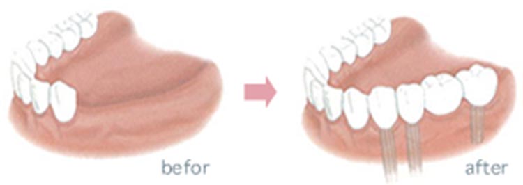 数本のインプラントの図