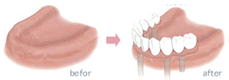 複数本のインプラントの図