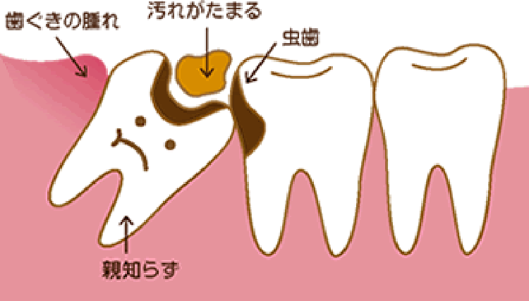 親知らずに汚れがたまり虫歯が進行する図