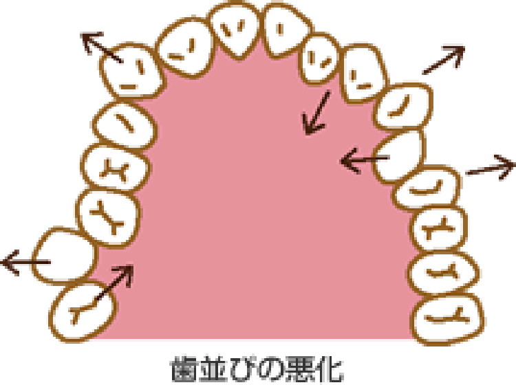 歯並びの悪化の図