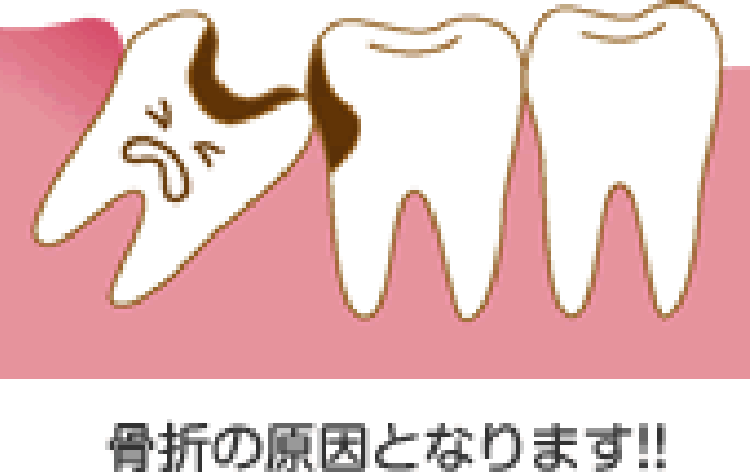 親知らずが顎の骨折の原因となる図