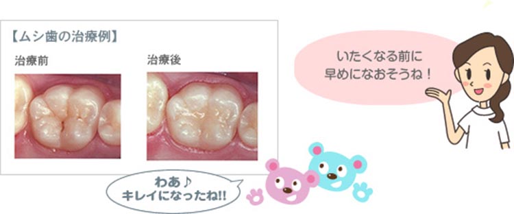 虫歯の治療例の画像
