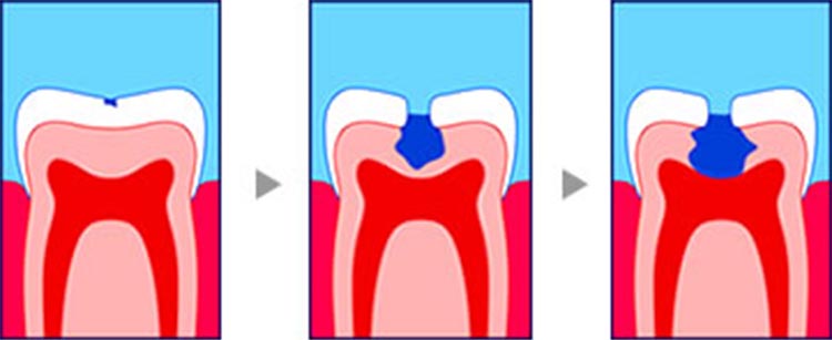 虫歯が表面から神経まで進行する図