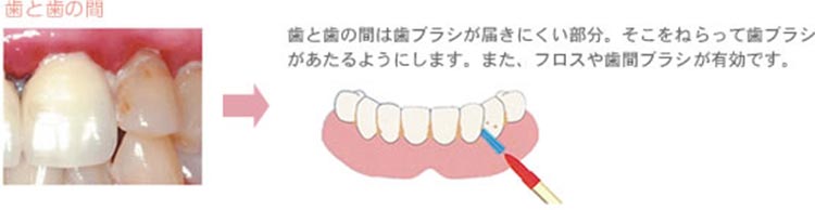 歯と歯の間は歯ブラシが届きにくい部分。そこをねらって歯ブラシがあたるようにします。また、フロスや歯間ブラシが有効です。